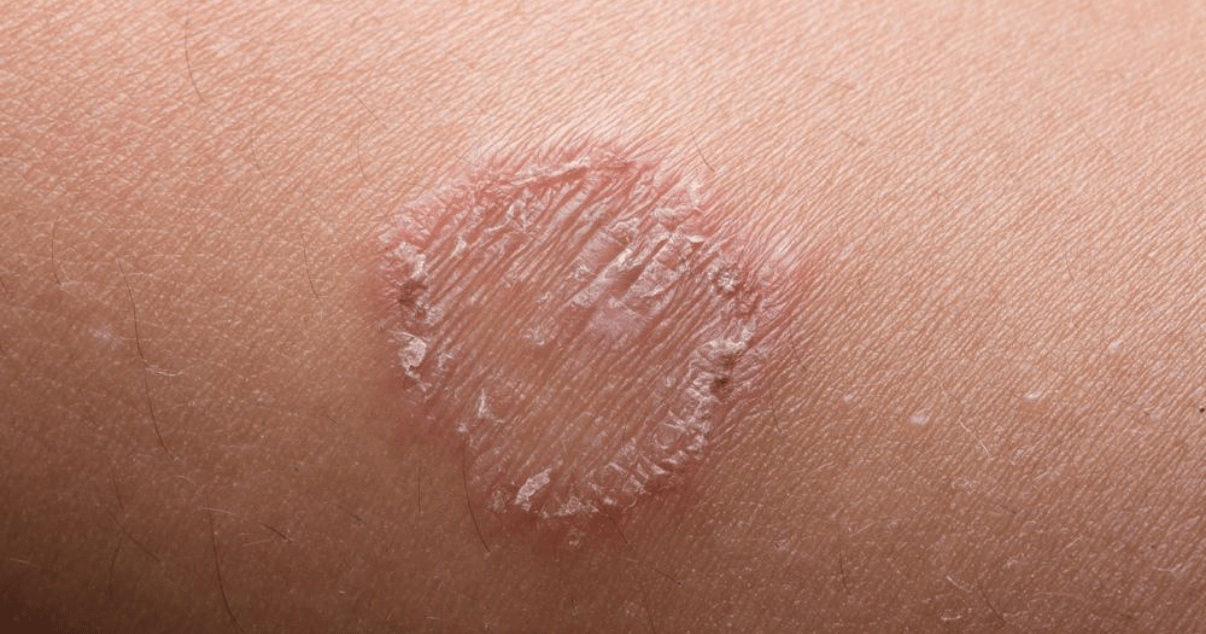 what is jock itch fungal infection of the skin on the inner thigh jock itch picture