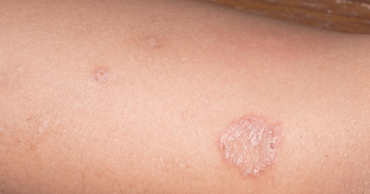 itchy red circular rash caused by ring worm