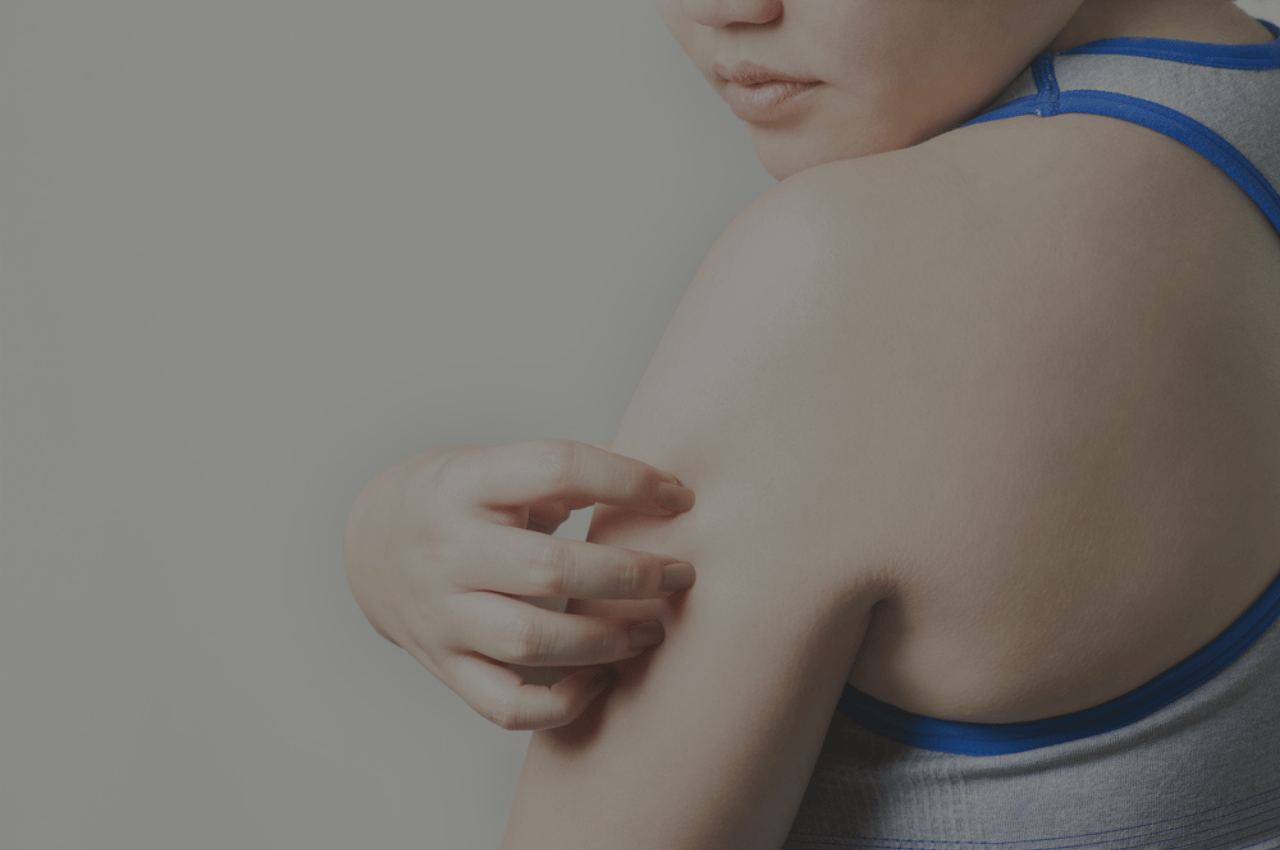 woman with ringworm from the gym wondering how to prevent jock itch and ringworm from the gym woman with ringworm from the gym wondering how to prevent jock itch and ringworm from the gym
