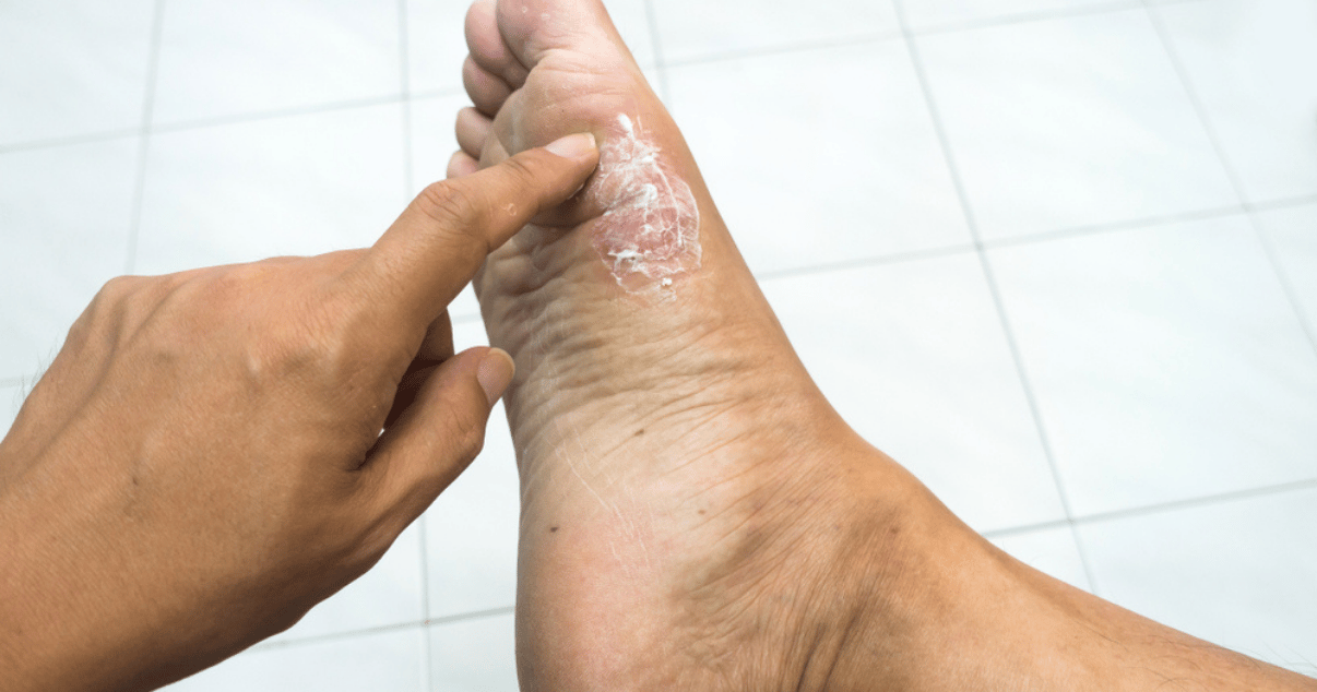 Man finding out that he has athletes foot not foot eczema now able to start treatment with antifungal cream