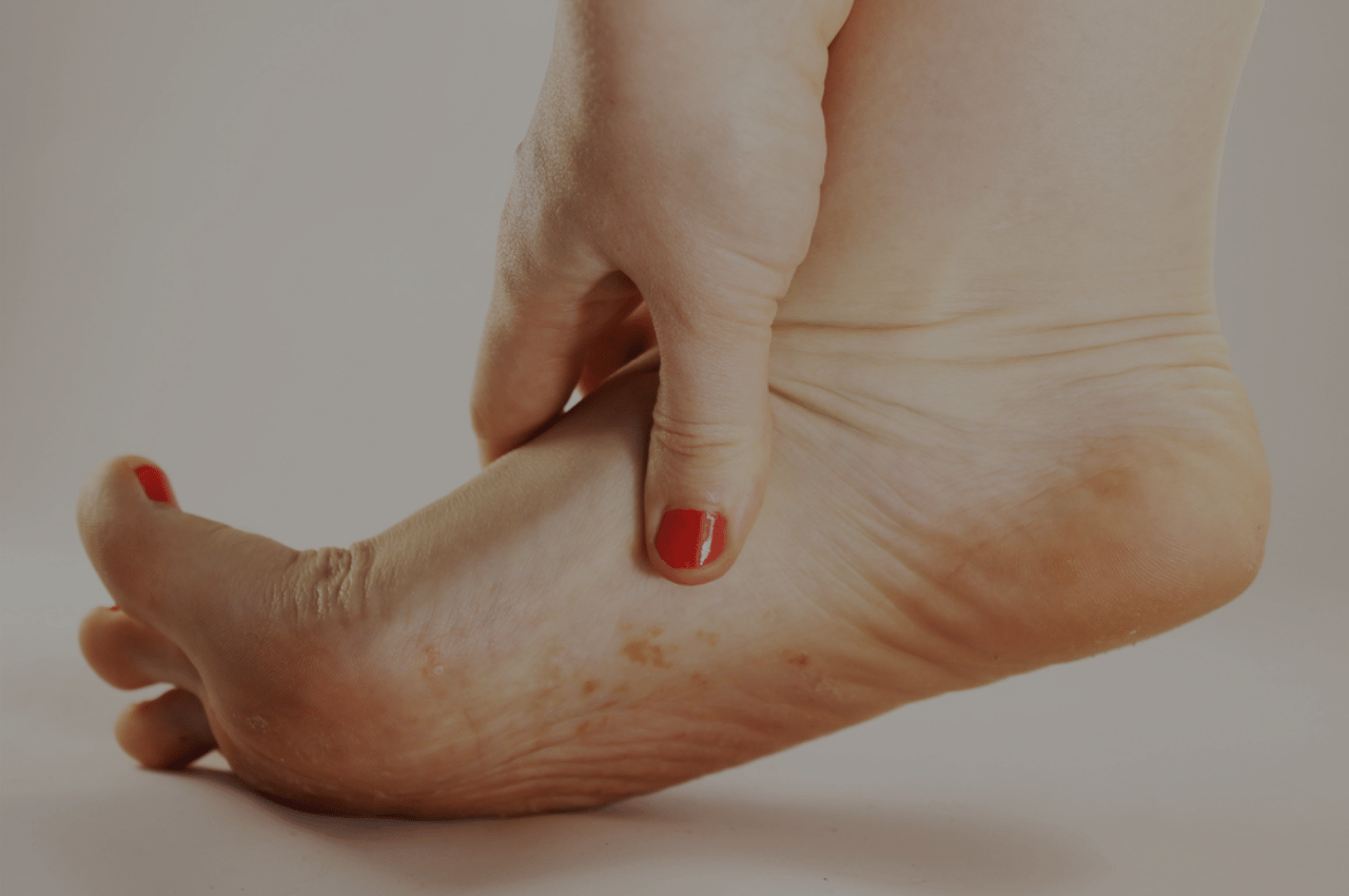 Woman with itchy foot wondering if she has foot eczema or athletes foot Woman with itchy foot wondering if she has foot eczema or athletes foot