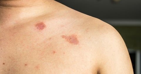 is ringworm contagous? yes