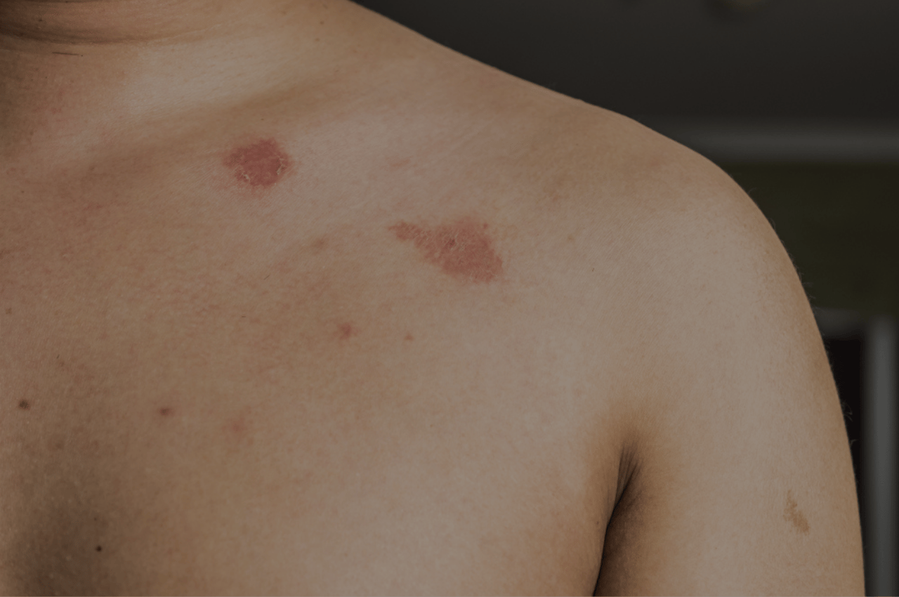 is ringworm contagous? yes is ringworm contagous? yes