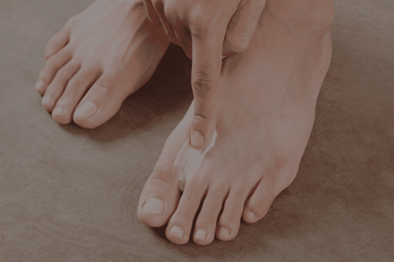 cure athlete's foot at home fast with silka cream cure athlete's foot at home fast with silka cream