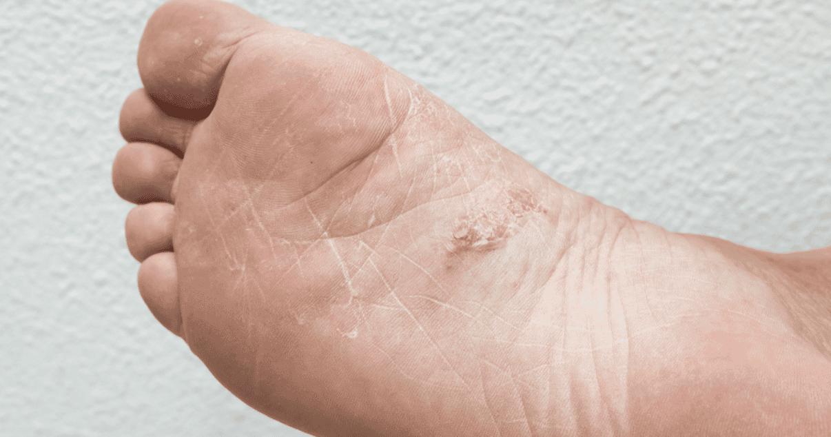 Athletes foot infection that can spread to others