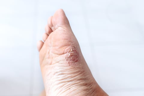 how to prevent athletes foot with athelte