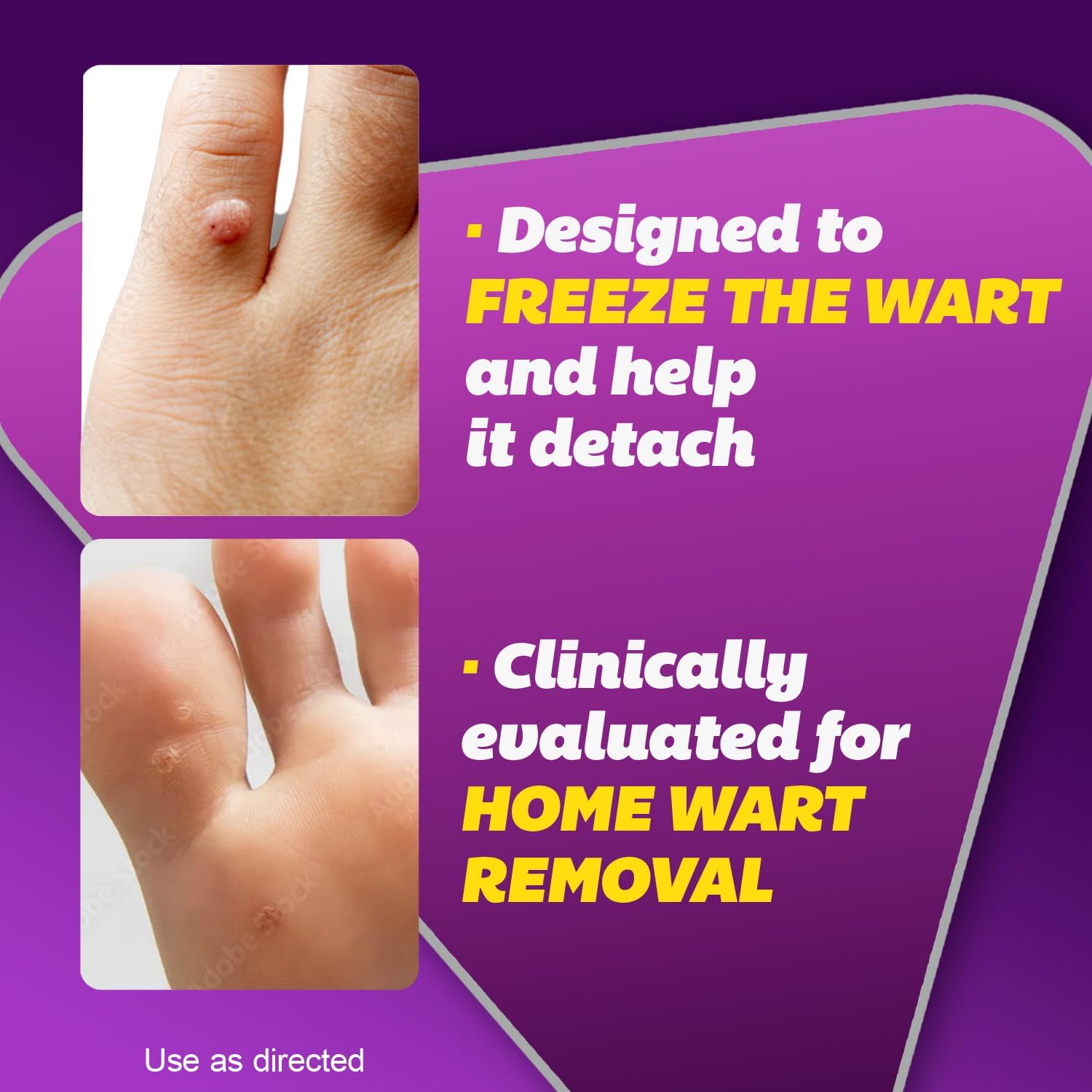 3-silka-pointts-wart