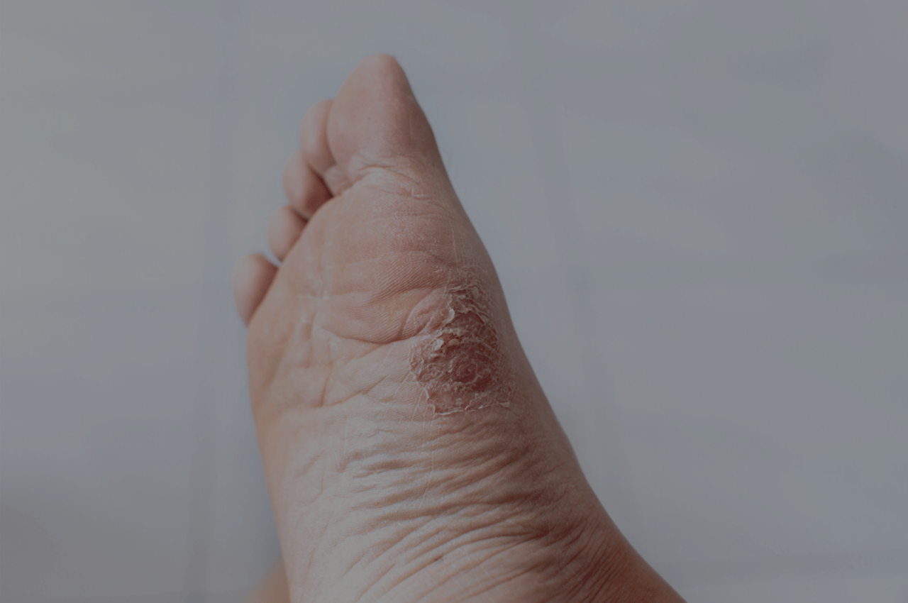 how to prevent athletes foot with athelte's foot images how to prevent athletes foot with athelte's foot images
