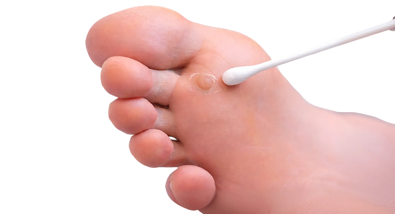 hero-warts